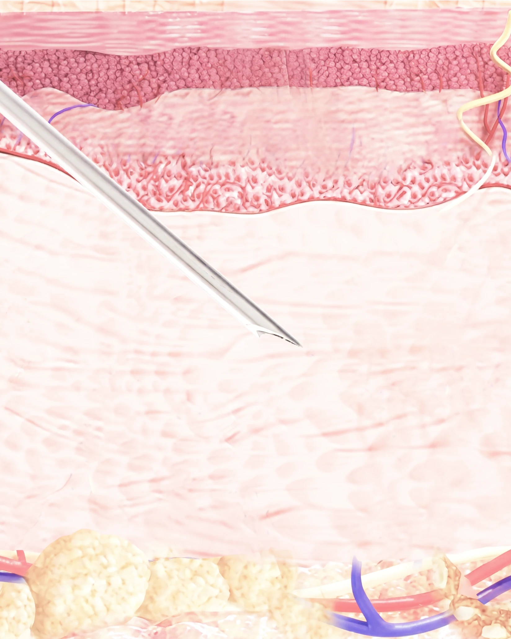 Injection into areas of concern