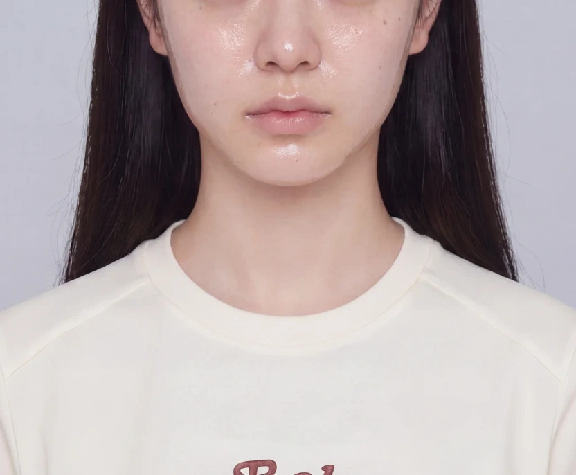 시술 4주 후