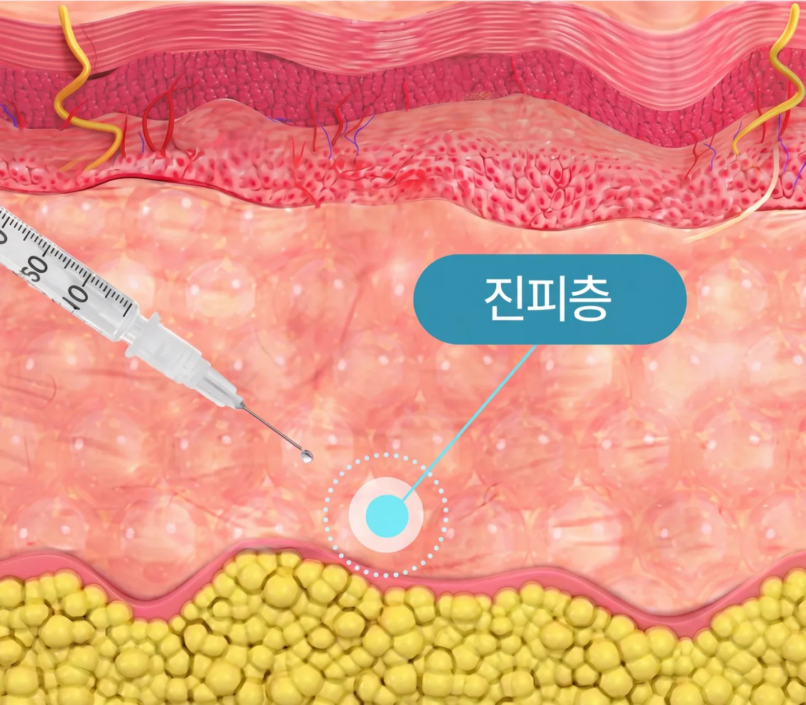 Skinvive injected into the dermis